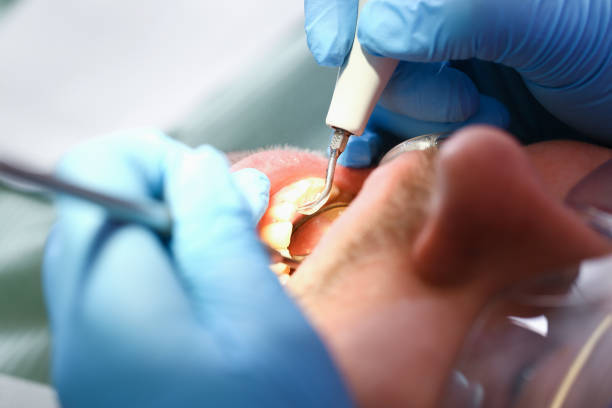 Best Broken or Cracked Tooth Emergency Dentist in Geneva, NY